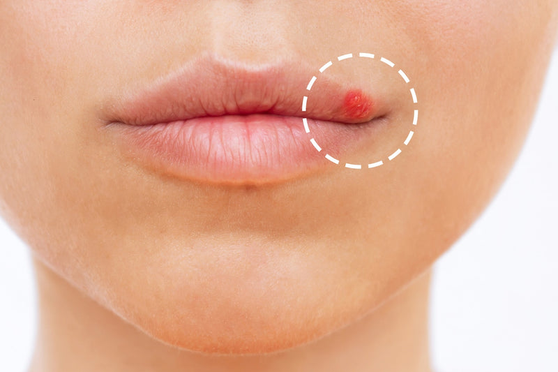 Close up of herpes on the lip. Blisters on the mouth of a young woman