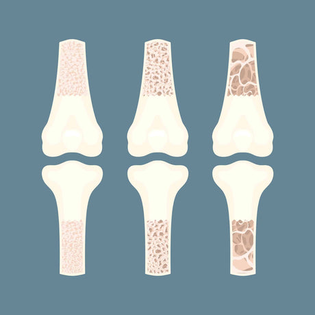 Osteoporosis bone density loss disease medical infographics