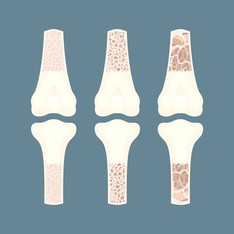 Osteoporosis bone density loss disease medical infographics