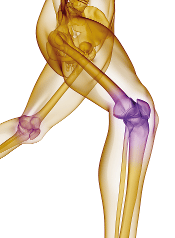 Arthrose verursacht Schmerzen in den Gelenken (hier: Kniegelenk)