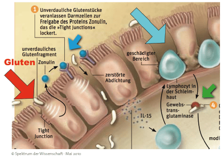 Leaky Gut Syndrom (Schemazeichnung)