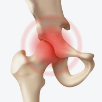 Schmerzen und Arthrose im Hüftgelenk